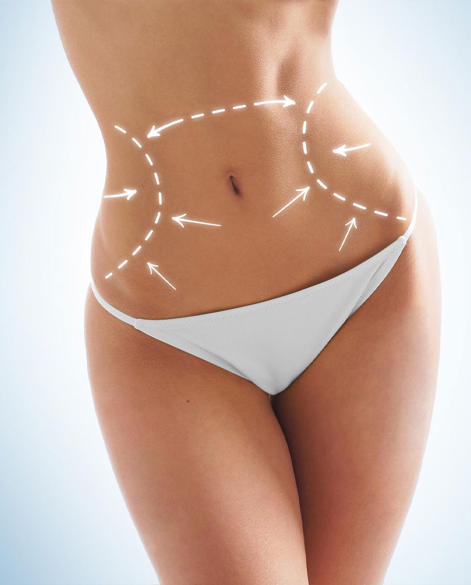 Abdominoplastia